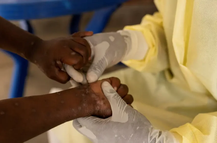  Brasil registra 88 casos de Mpox em 2026; saiba como evitar a doença